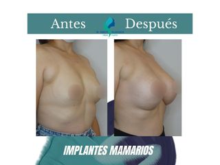 Pre y Postoperatorio de 8 meses de implantes mamarios