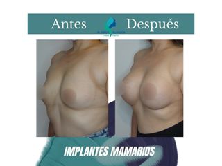 Pre y Postoperatorio de 8 meses de implantes mamarios