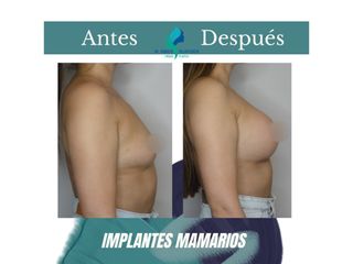 Pre y Postoperatorio de 3 semanas de implantes mamarios
