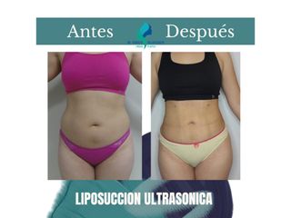 Liposuccion ultrasonica- Pre y Postoperatorio de 45 días