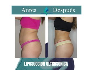 Liposuccion ultrasonica- Pre y Postoperatorio de 45 días