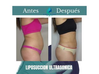 Liposuccion ultrasonica- Pre y Postoperatorio de 45 días
