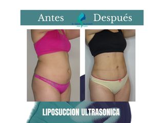 Liposuccion ultrasonica- Pre y Postoperatorio de 45 días