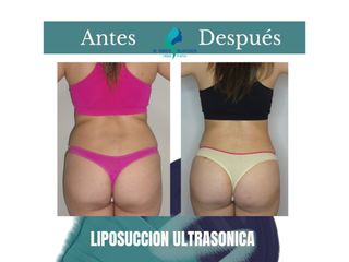 Liposuccion ultrasonica- Pre y Postoperatorio de 45 días