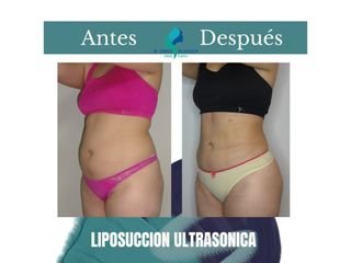 Liposuccion ultrasonica- Pre y Postoperatorio de 45 días