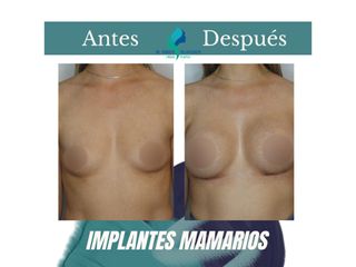 Aumento mamario - Dr. Rodolfo Villavicencio