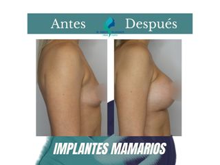 Aumento mamario - Dr. Rodolfo Villavicencio