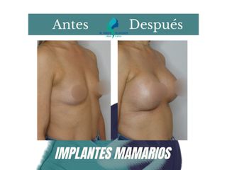 Aumento mamario - Dr. Rodolfo Villavicencio