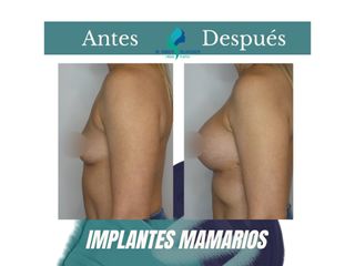 Aumento mamario - Dr. Rodolfo Villavicencio
