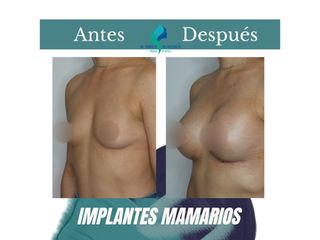 Aumento mamario - Dr. Rodolfo Villavicencio