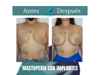 Mastopexia con implantes - Dr. Rodolfo Villavicencio