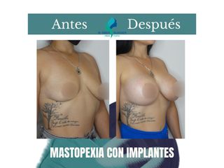 Mastopexia con implantes - Dr. Rodolfo Villavicencio