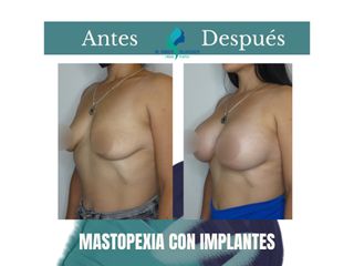 Mastopexia con implantes - Dr. Rodolfo Villavicencio