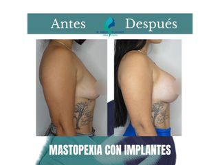 Mastopexia con implantes - Dr. Rodolfo Villavicencio