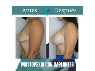 Mastopexia con implantes - Dr. Rodolfo Villavicencio