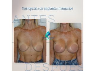 Mastopexia con implantes - Dr. Rodolfo Villavicencio