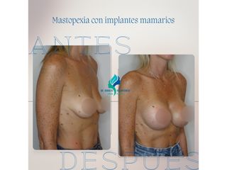 Mastopexia con implantes - Dr. Rodolfo Villavicencio