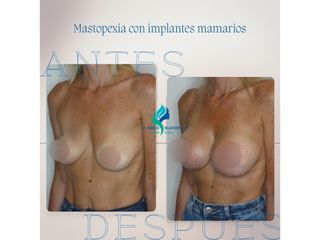 Mastopexia con implantes - Dr. Rodolfo Villavicencio