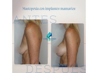 Mastopexia con implantes - Dr. Rodolfo Villavicencio
