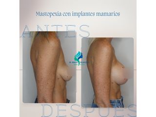 Mastopexia con implantes - Dr. Rodolfo Villavicencio