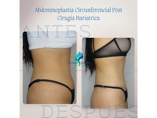 Dermolipectomia Circunferencial Post Cirugía Bariatrica - Dr. Rodolfo Villavicencio