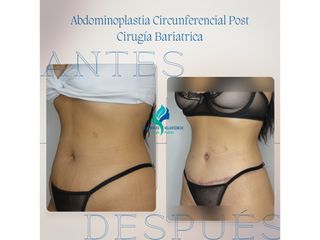 Dermolipectomia Circunferencial Post Cirugía Bariatrica - Dr. Rodolfo Villavicencio