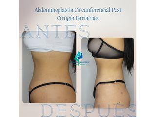 Dermolipectomia Circunferencial Post Cirugía Bariatrica