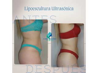 Lipoescultura - Dr. Rodolfo Villavicencio