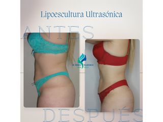Lipoescultura - Dr. Rodolfo Villavicencio