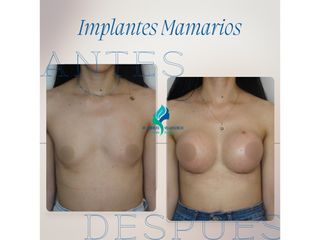 Aumento mamario - Dr. Rodolfo Villavicencio