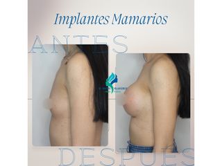 Aumento mamario - Dr. Rodolfo Villavicencio