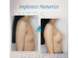 Aumento mamario - Dr. Rodolfo Villavicencio