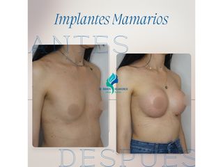 Aumento mamario - Dr. Rodolfo Villavicencio