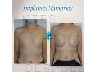 Pre y Postoperatorio de 8 meses de implantes mamarios 300 cc