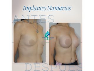 Pre y Postoperatorio de 8 meses de implantes mamarios 300 cc