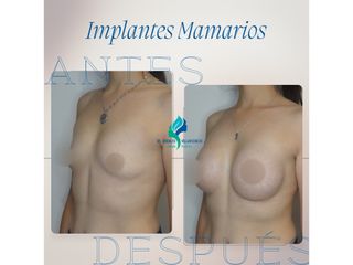 Pre y Postoperatorio de 8 meses de implantes mamarios 300 cc