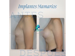 Pre y Postoperatorio de 8 meses de implantes mamarios 300 cc