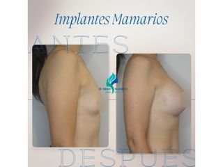 Pre y Postoperatorio de 8 meses de implantes mamarios 300 cc