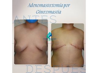 Ginecomastia - Dr. Rodolfo Villavicencio