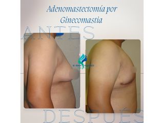 Ginecomastia - Dr. Rodolfo Villavicencio