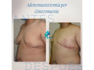 Ginecomastia - Dr. Rodolfo Villavicencio