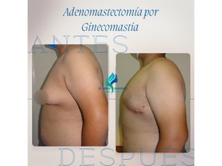 Ginecomastia - Dr. Rodolfo Villavicencio