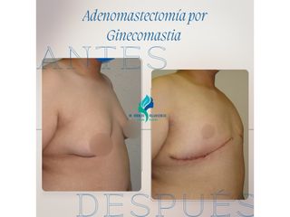 Ginecomastia - Dr. Rodolfo Villavicencio