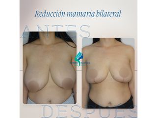 Reducción mamaria bilateral - Dr. Rodolfo Villavicencio