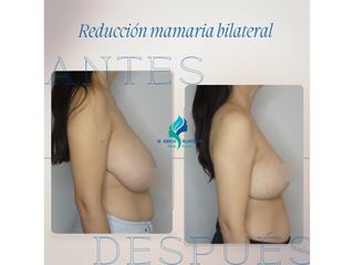Reducción mamaria bilateral - Dr. Rodolfo Villavicencio