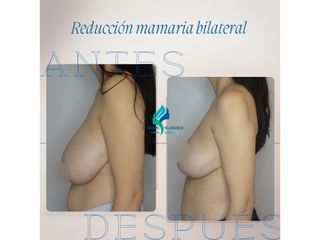 Reducción mamaria bilateral - Dr. Rodolfo Villavicencio