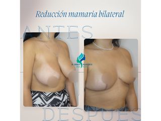 Reducción mamas - Dr. Rodolfo Villavicencio