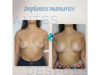 Aumento mamario - Dr. Rodolfo Villavicencio