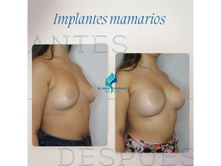 Aumento mamario - Dr. Rodolfo Villavicencio