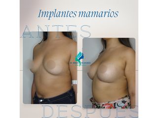 Aumento mamario - Dr. Rodolfo Villavicencio